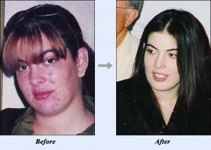 Acne No More Before & After