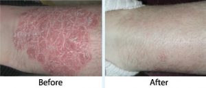 Psoriasis Revolution Reviews